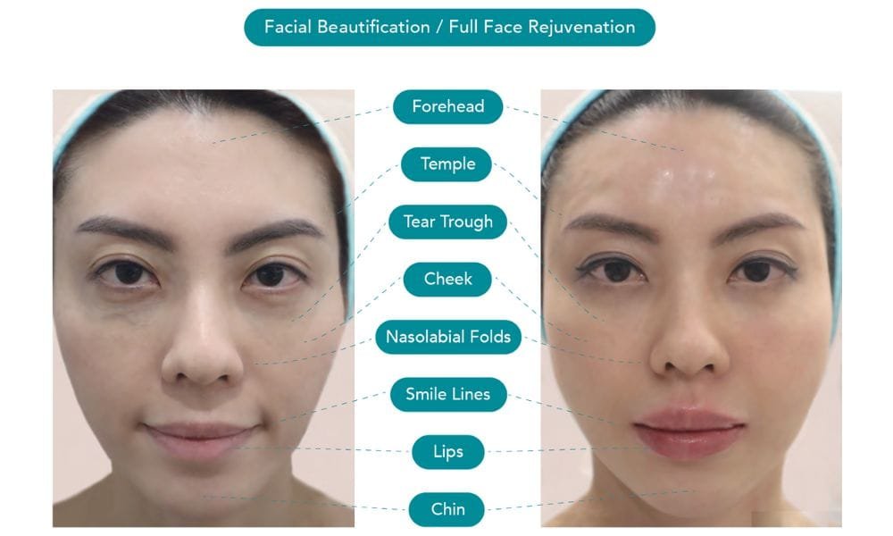 Filler Treatment